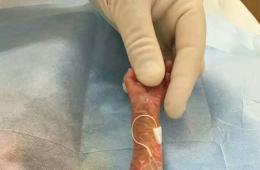 我院成熟开展新生儿PICC置管术